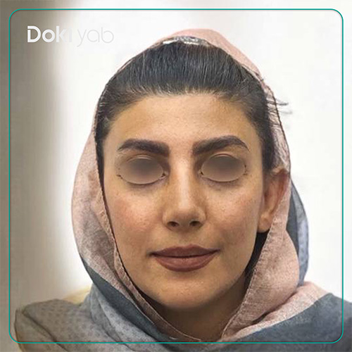 نمونه کار رینوپلاستی دکتر دنیا کرمی در شیراز