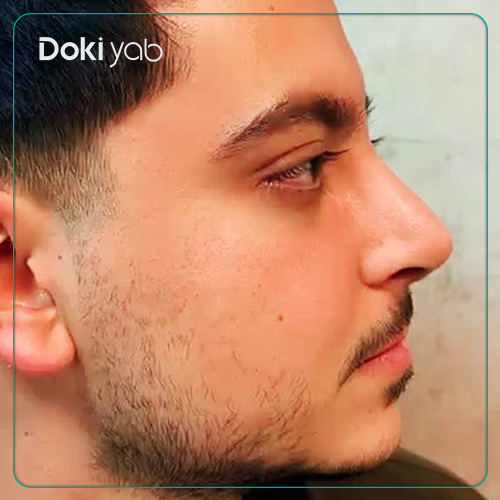 نمونه کار رینوپلاستی طبیعی مردانه دکتر نگار جعفری در شیراز