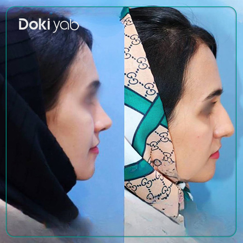 نمونه کار رینوپلاستی نچرال دکتر داریوش ساریخانی در شیراز