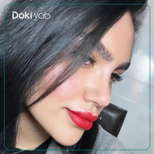 نمونه کار رینوپلاستی نیمه فانتری دکتر آرش سبحان منش
