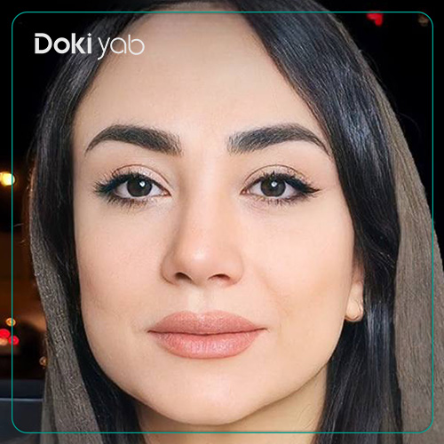 نمونه کار رینوپلاستی طبیعی دکتر مسیح طالع