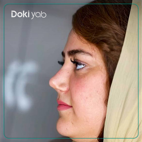 نمونه کار عمل بینی به سبک فانتزی توسط دکتر لیلا اسدپور جراح بینی در شیراز
