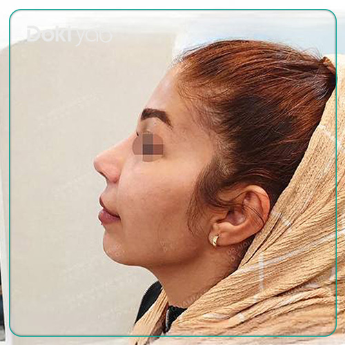 نمونه کار عمل بینی به سبک فانتزی توسط دکتر محمد مهدی ده بزرگی