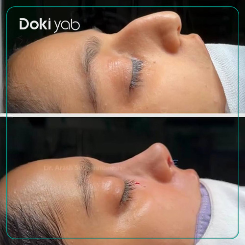 نمونه کار عمل بینی به سبک نیمه فانتری توسط دکتر آرش سبحان منش