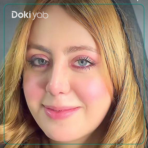 نمونه کار عمل بینی توسط دکتر لطفعلی نوروزی جراح بینی در شیراز