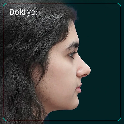 نمونه کار عمل بینی دخترانه دکتر محسن روشنی در شیراز