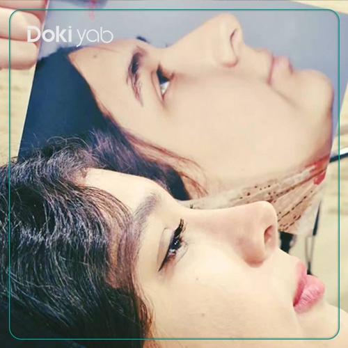نمونه کار عمل بینی دکتر آزاده مرادی جراح بینی در شیراز