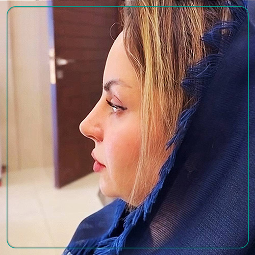 نمونه کار عمل بینی دکتر امین میر احمدی جراح بینی در شیراز