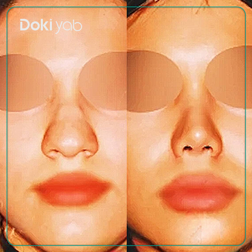 نمونه کار عمل بینی دکتر بیژن ربیعی جراح بینی در شیرازَ
