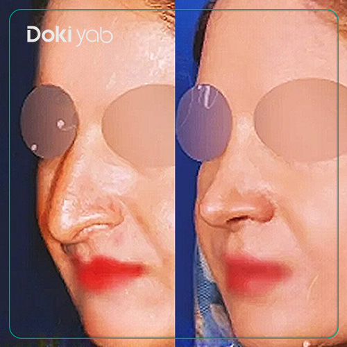 نمونه کار عمل بینی دکتر بیژن ربیعی در شیرازَ