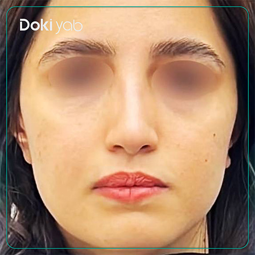 نمونه کار عمل بینی دکتر دنیا کرمی در شیراز