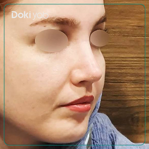 نمونه کار عمل بینی دکتر رضا کبودخانی