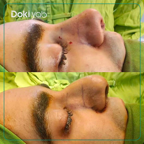 نمونه کار عمل بینی دکتر سعید مرزبان جراح بینی در شیراز