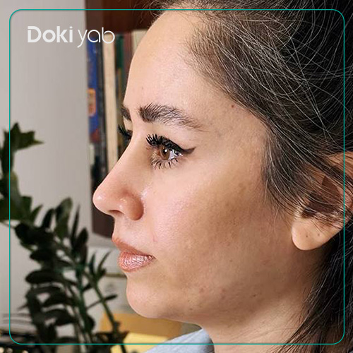 نمونه کار عمل بینی دکتر علیرضا مصباحی به سبک نچرال