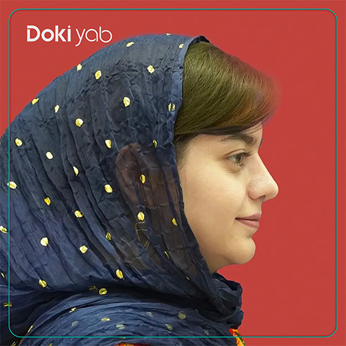 نمونه کار عمل بینی دکتر محسن روشنی در شیراز