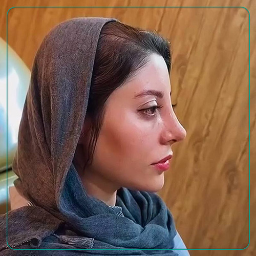نمونه کار عمل بینی زنانه دکتر امین میر احمدی جراح بینی در شیراز