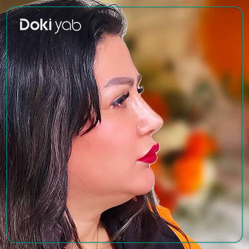 نمونه کار عمل بینی زنانه دکتر لطفعلی نوروزی جراح بینی در شیراز