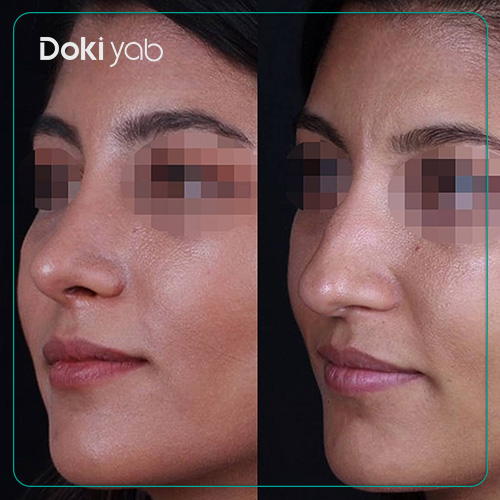 نمونه کار عمل بینی زنانه دکتر وحید عین آبادی جراح بینی در شیراز