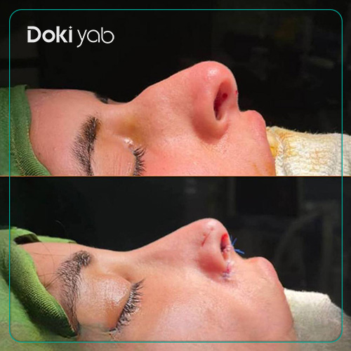 نمونه کار عمل بینی طبیعی دکتر بهروز گندمی