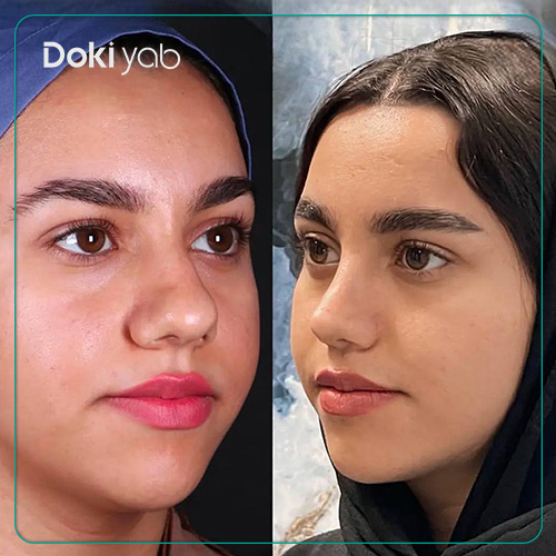 نمونه کار عمل بینی طبیعی دکتر سلمان شاکری