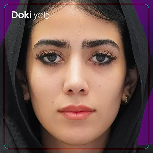 نمونه کار عمل بینی طبیعی دکتر محسن روشنی جراح بینی در شیراز