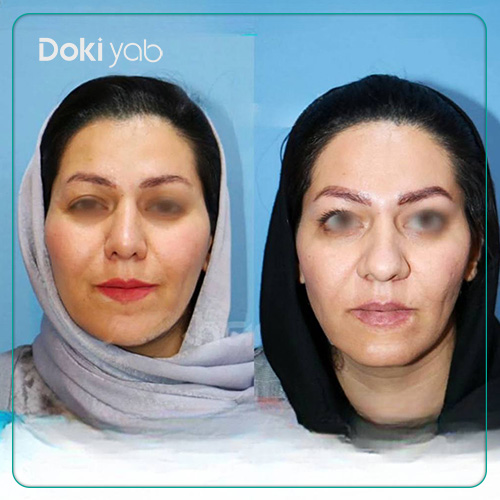 نمونه کار عمل بینی طبیعی زنانه دکتر داریوش ساریخانی در شیراز