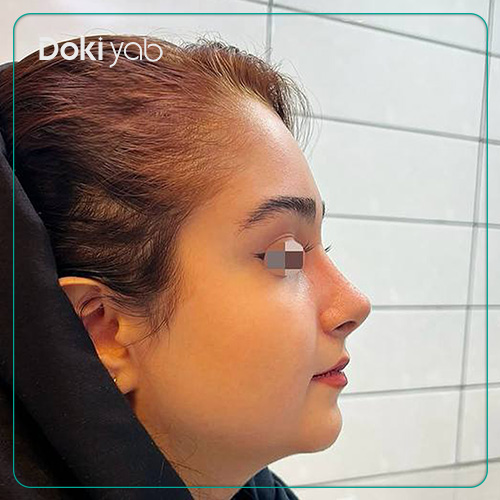 نمونه کار عمل بینی طبیعی توسط دکتر مجتبی قائدی در شیراز