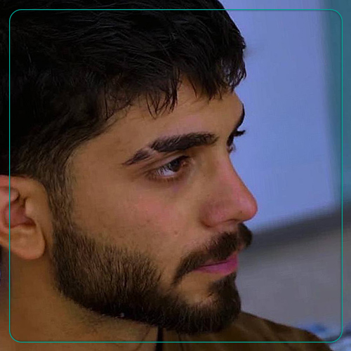 نمونه کار عمل بینی مردانه دکتر امین میر احمدی جراح بینی در شیراز