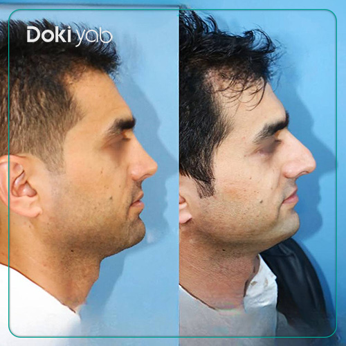 نمونه کار عمل بینی مردانه دکتر داریوش ساریخانی