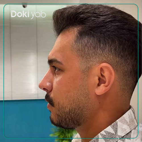 نمونه کار عمل بینی مردانه طبیعی توسط دکتر علیرضا مصباحی