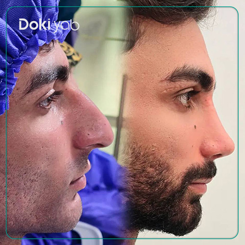 نمونه کار عمل بینی مردانه طبیعی دکتر حسین کرم نژاد