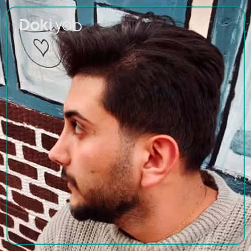 نمونه کار عمل بینی مردانه طبیعی دکتر خسرو خسروی