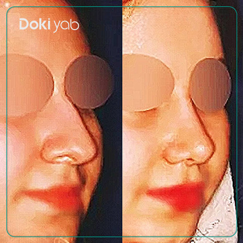 نمونه کار عمل بینی نچرال دکتر بیژن ربیعی جراح بینی در شیرازَ