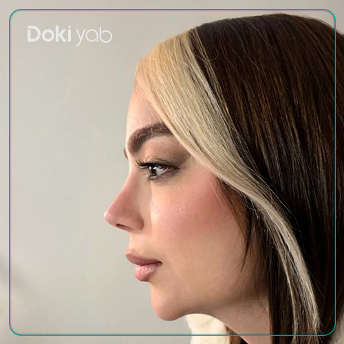 نمونه کار عمل بینی نیمه فانتری دخترانه توسط دکتر آرش سبحان منش