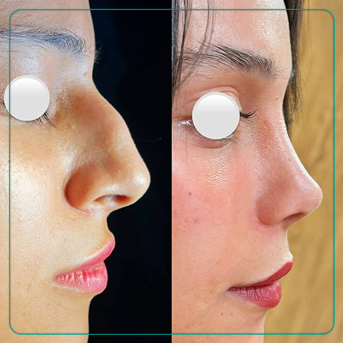 نمونه کار عمل بینی نیمه فانتزی دکتر امین میر احمدی جراح بینی در شیراز