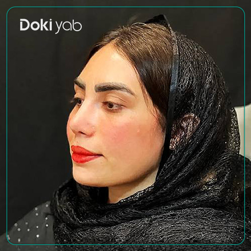 نمونه کار عمل بینی نیمه فانتزی دکتر لیلا اسدپور جراح بینی در شیراز