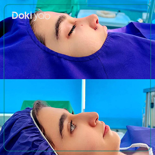 نمونه کار عمل بینی نیمه فانتزی زنانه توسط دکتر حسین کرم نژاد