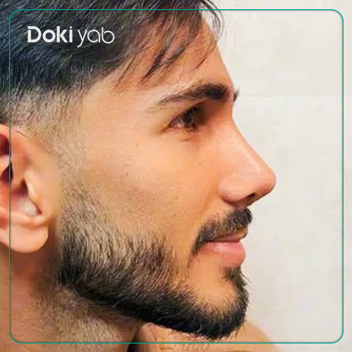 نمونه کار عمل بینی نیمه فانتزی مردانه دکتر نگار جعفری