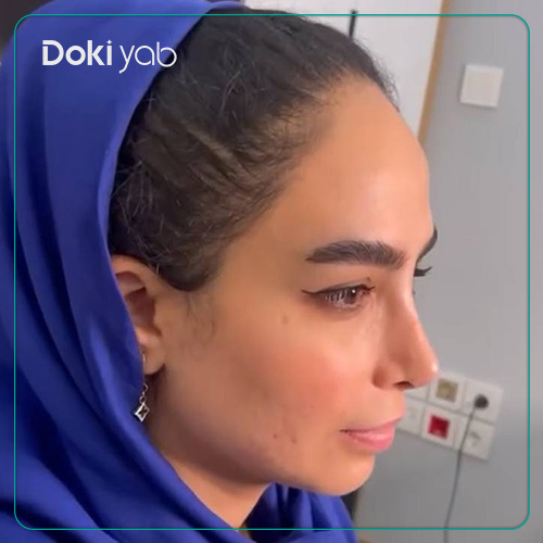 نمونه کار رینوپلاستی طبیعی دکتر شهریار شاهمرادی