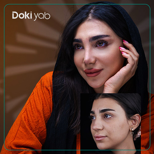 نمونه کار قبل و بعد از عمل بینی با مشاوره تیم دکی یاب