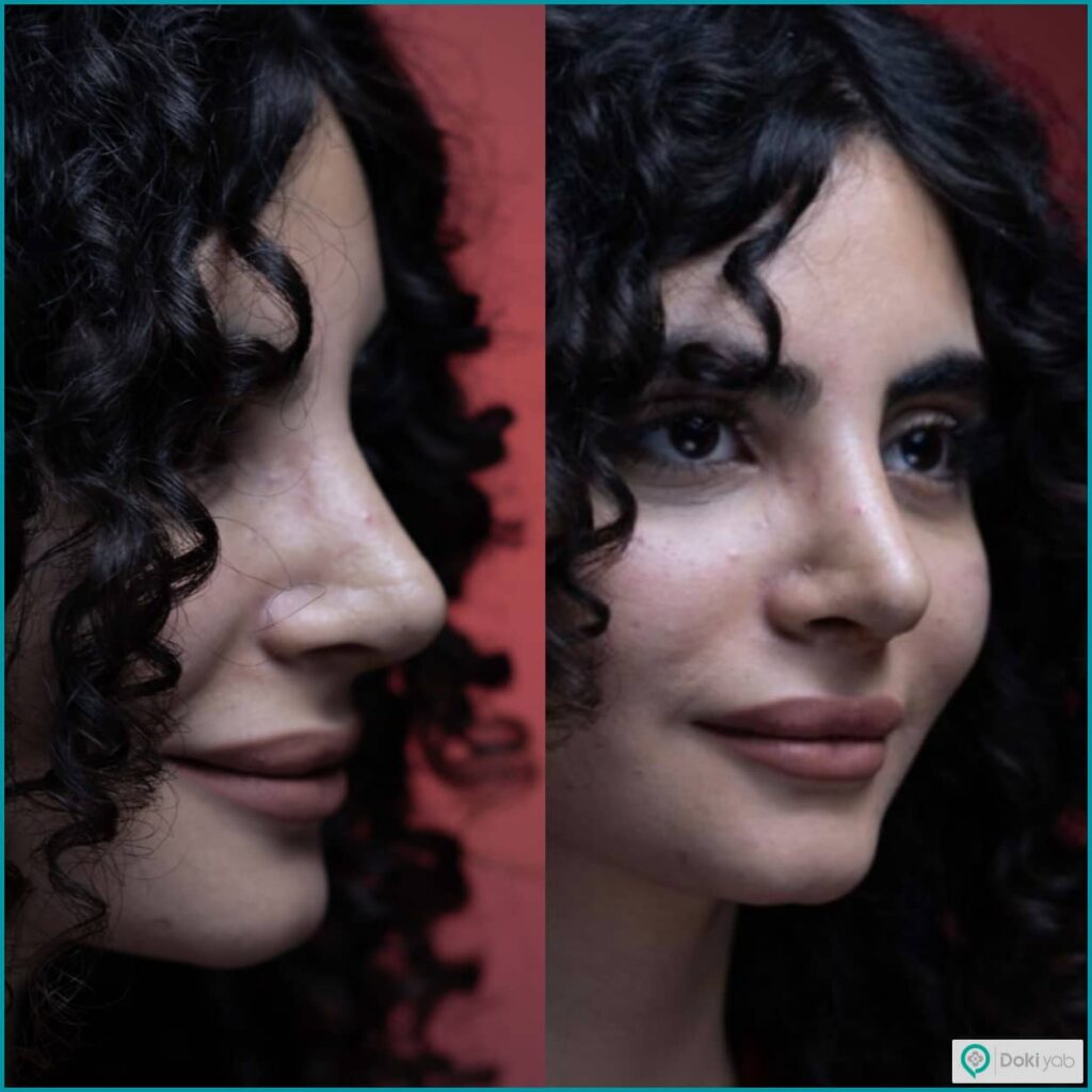 بهترین جراحان عمل بینی طبیعی؛ مجموعه دکی یاب