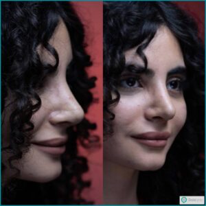 بهترین جراحان عمل بینی طبیعی؛ مجموعه دکی یاب