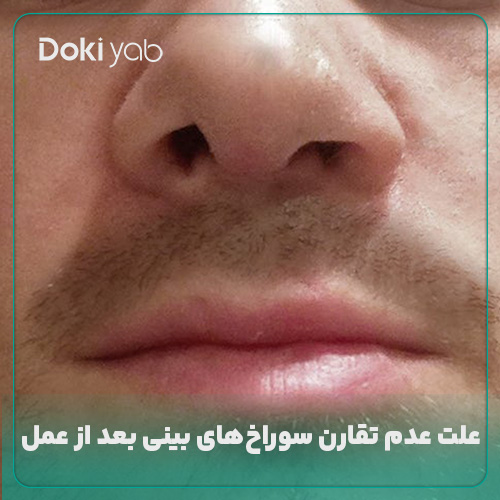 بررسی علت متقارن نبودن سوراخ های بینی بعد از عمل