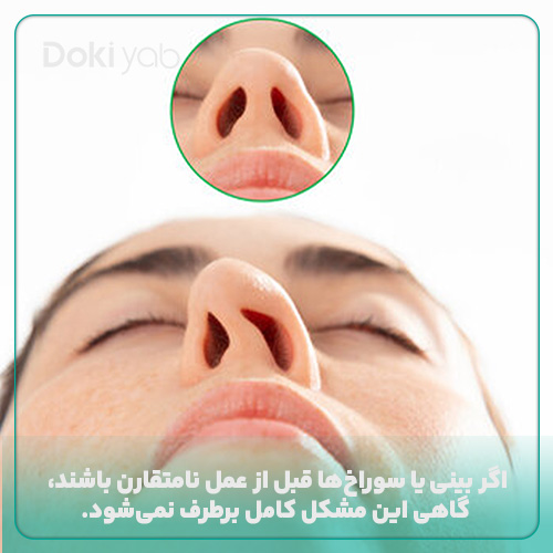 عدم تقارن قبل از عمل، دلیل متقارن نشدن بینی بعد از عمل است