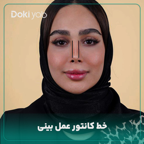 خط کانتور در عمل بینی؛ نمونه بینی عمل شده با مشاوره دکی یاب