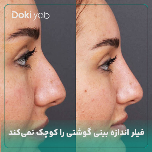 فیلر بینی گوشتی، اندازه بینی را کوچک نمی‌کند؛ مجله دکی یاب