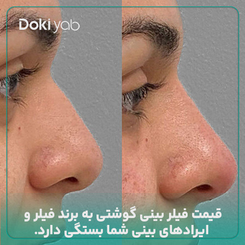 عکس فیلر بینی گوشتی  در مجله دکی یاب