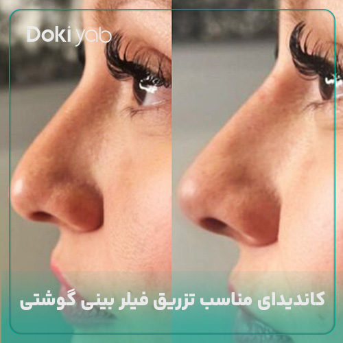عکس فیلر بینی گوشتی؛ بررسی کاندیدای مناسب تزریق ژل در مجله دکی یاب