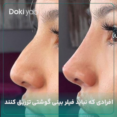 عکس فیلر بینی گوشتی در مجله دکی یاب
