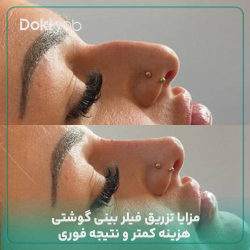 مزایای تزریق ژل دماغ پهن؛ عکس فیلر بینی گوشتی در مجله دکی یاب
